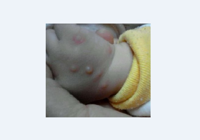 Prevention of chickenpox